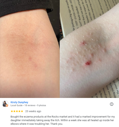 Eczema less® Treatment Cream | ALOE ACTIVE™ - Eczema Treatment Cream