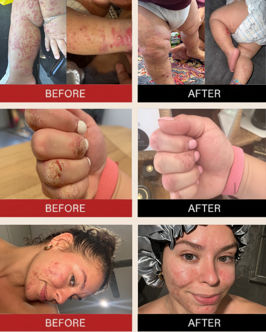 Eczema & Psoriasis Treatment Pack