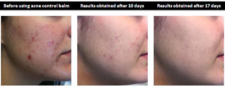 aloe vera plant for acne before and after ALOE ACTIVE™ Acne Control Balm – Aloe Vera Cosmetics Australia
